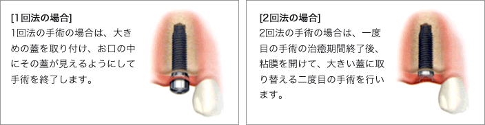 1回法の場合、2回法の場合